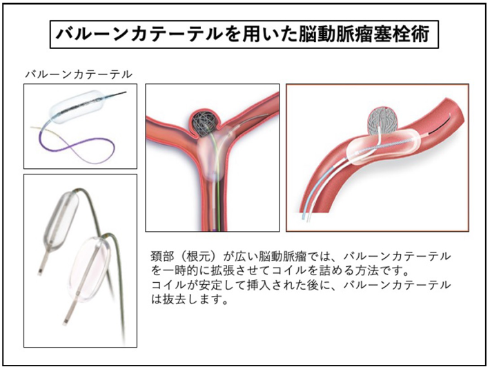 バルーンカテーテル