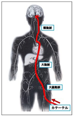脳血管内治療の方法