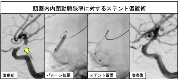 血管拡張術03