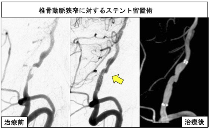 血管拡張術04