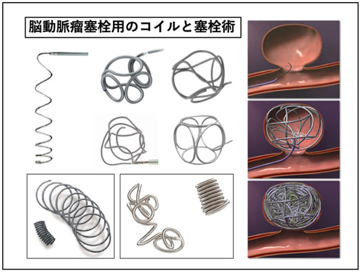 コイル塞栓術
