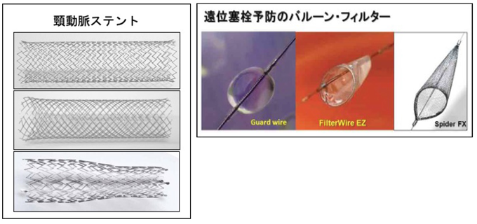 ステント留置