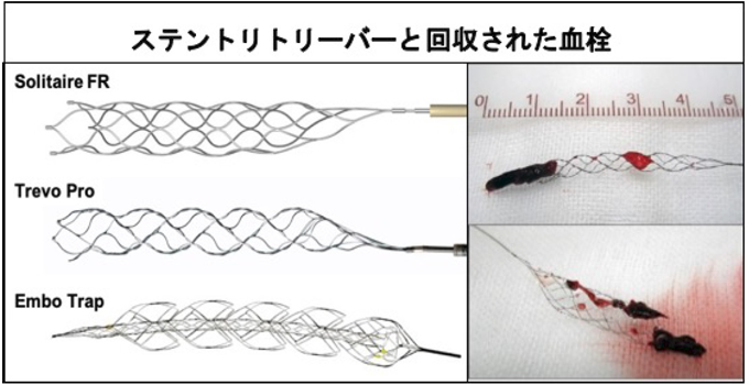 ステントリトリーバー