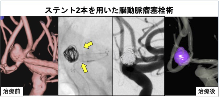 ステントを2本