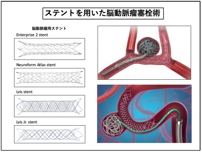 ステント塞栓