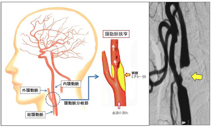 頚動脈ステント留置術