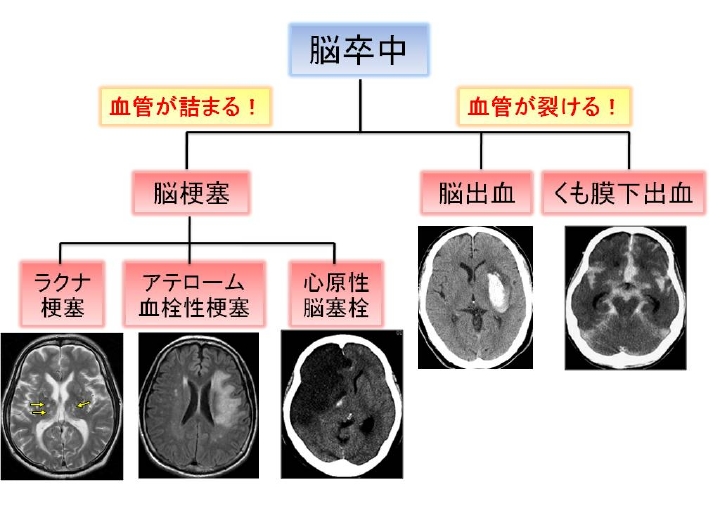 脳卒中とは脳卒中センター 川崎市の東横病院の脳卒中科（脳神経内科） 脳神経外科